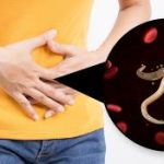 tratament naturist viermi intestinali